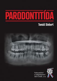 Parodontitída
